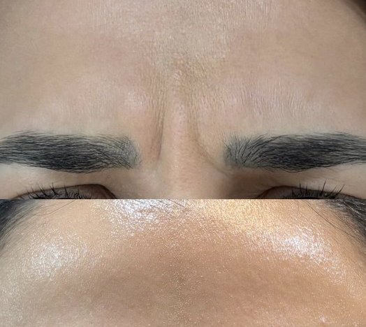 Botox antes e depois