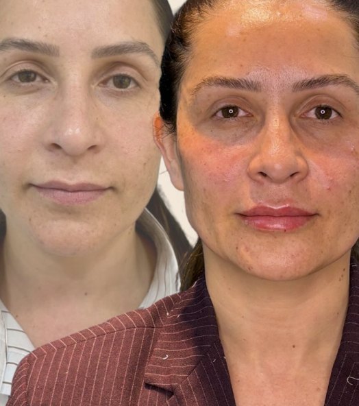 Harmonização facial antes e depois