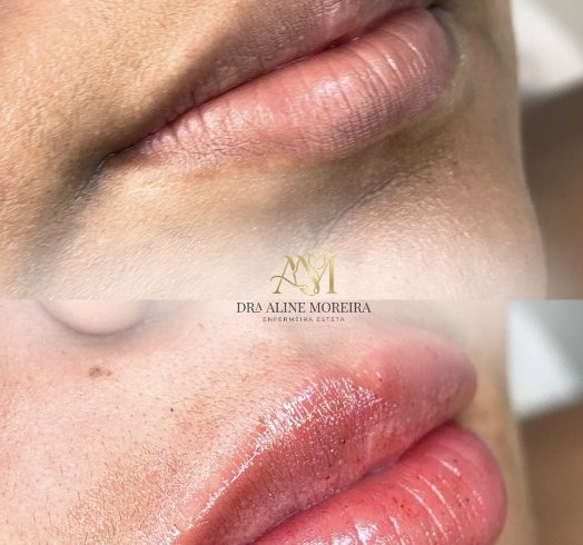 Antes e depois de preenchimento labial